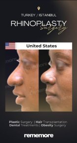 نتائج قبل وبعد عملية تجميل الأنف التصحيحية في مستشفى ميموريال شيشلي، إعادة تشكيل الأنف