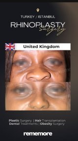 نتائج عملية تجميل الأنف قبل وبعد في مستشفى ميموريال شيشلي، تحسين شكل الأنف