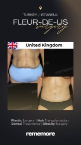 before-after photo fleur-de-lis-tummy-tuck