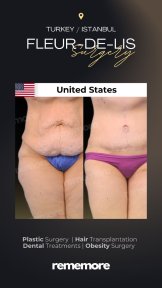 before-after photo fleur-de-lis-tummy-tuck