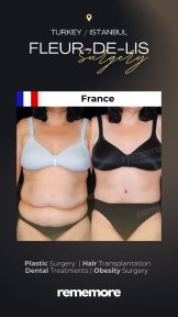 before-after photo fleur-de-lis-tummy-tuck