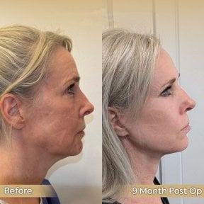 before-after photo deep-plane-facelift