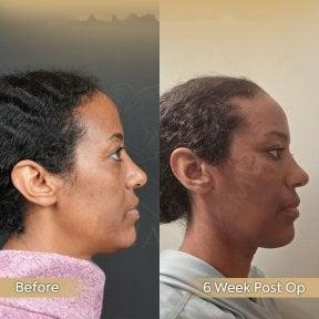 before-after photo endoscopic-facelift