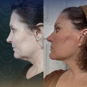before-after photo tightening-of-facial-skin-facelift