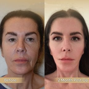 before-after photo tightening-of-facial-skin-facelift