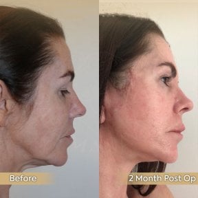 before-after photo tightening-of-facial-skin-facelift