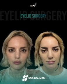 before-after photo upper-eyelid-surgery
