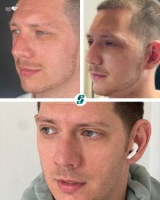 before-after photo upper-eyelid-surgery