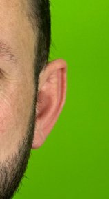 before-after photo otoplasty-ear-surgery