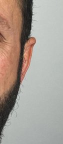 before-after photo otoplasty-ear-surgery