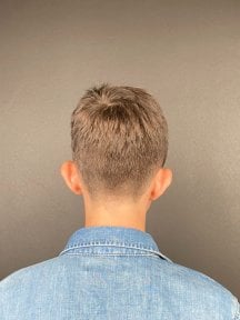 before-after photo otoplasty-ear-surgery