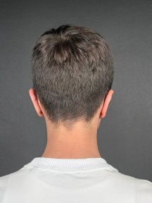 before-after photo otoplasty-ear-surgery
