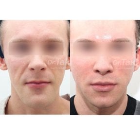 before-after photo tightening-of-facial-skin-facelift
