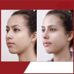 before-after photo rhinoplasty-nose-job