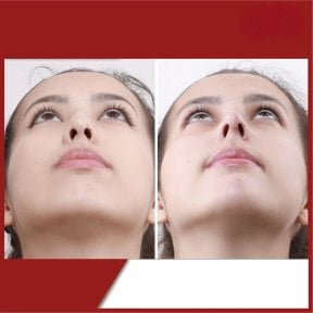 before-after photo rhinoplasty-nose-job