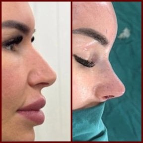 before-after photo rhinoplasty-nose-job