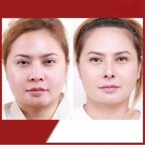 before-after photo rhinoplasty-nose-job