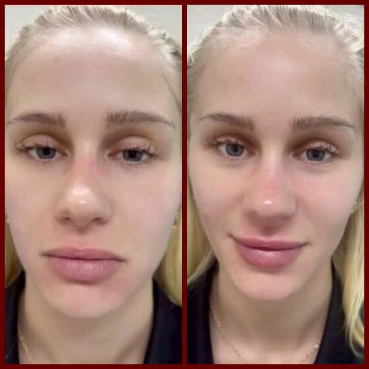 Antes y después de Ultherapy en DGB Clinic: resultados de tensado y lifting facial