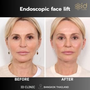 before-after photo lower-eyelid-surgery