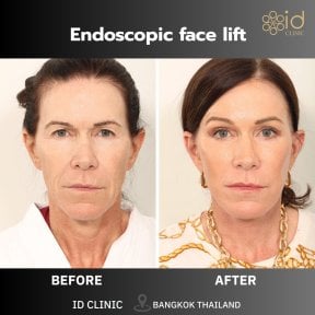 before-after photo lower-eyelid-surgery