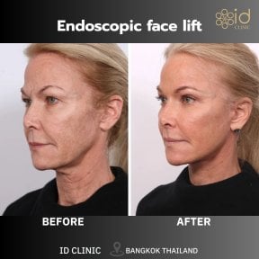 before-after photo lower-eyelid-surgery