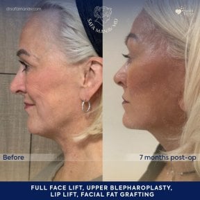 before-after photo tightening-of-facial-skin-facelift