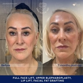 before-after photo tightening-of-facial-skin-facelift