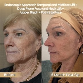 before-after photo tightening-of-facial-skin-facelift