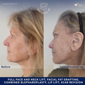 before-after photo tightening-of-facial-skin-facelift