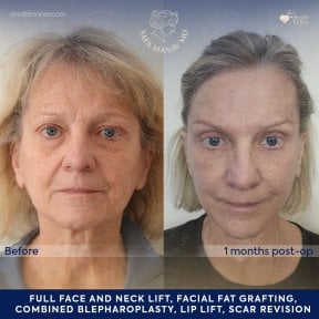 before-after photo tightening-of-facial-skin-facelift