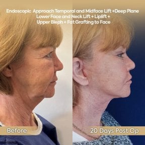 before-after photo tightening-of-facial-skin-facelift
