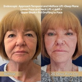 before-after photo tightening-of-facial-skin-facelift