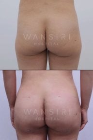 before-after photo buttock-lift