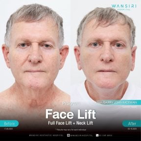 Before and after facelift and neck lift results at Wansiri Hospital, visible facial rejuvenation