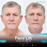 Before and after facelift and neck lift results at Wansiri Hospital, visible facial rejuvenation