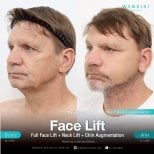 Before and after facelift, neck lift, chin augmentation results at Wansiri Hospital