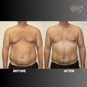 before-after photo vaser-liposuction