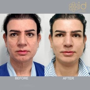 before-after photo deep-plane-facelift