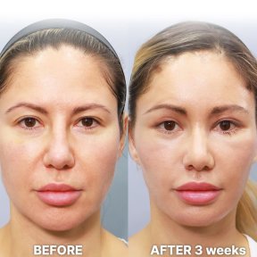 before-after photo deep-plane-facelift