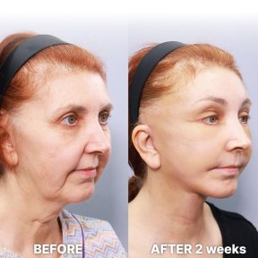 before-after photo deep-plane-facelift
