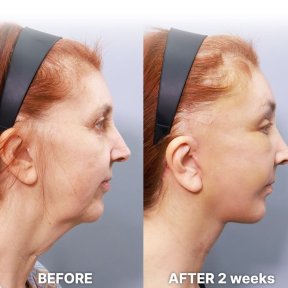 before-after photo deep-plane-facelift