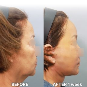 before-after photo deep-plane-facelift