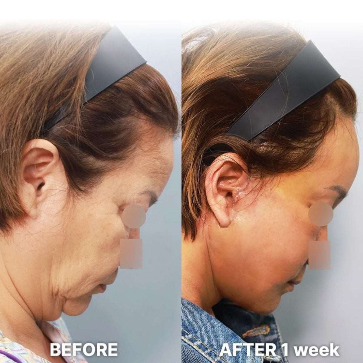 Resultado a 1 semana de Deep Plane Facelift en Returning Plastic Surgery, efecto lifting visible