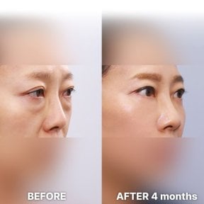 before-after photo blepharoplasty-eyelid