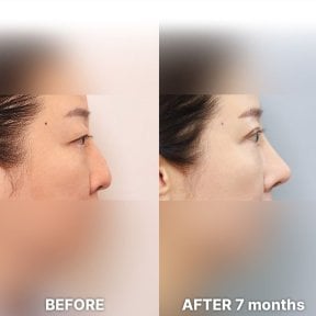 before-after photo blepharoplasty-eyelid