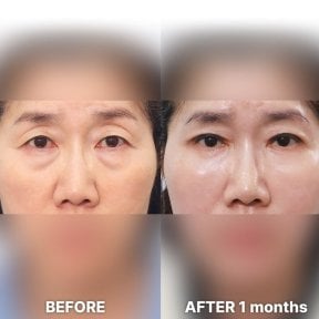 before-after photo blepharoplasty-eyelid