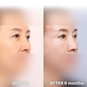 before-after photo blepharoplasty-eyelid