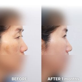 before-after photo blepharoplasty-eyelid