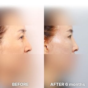 before-after photo blepharoplasty-eyelid