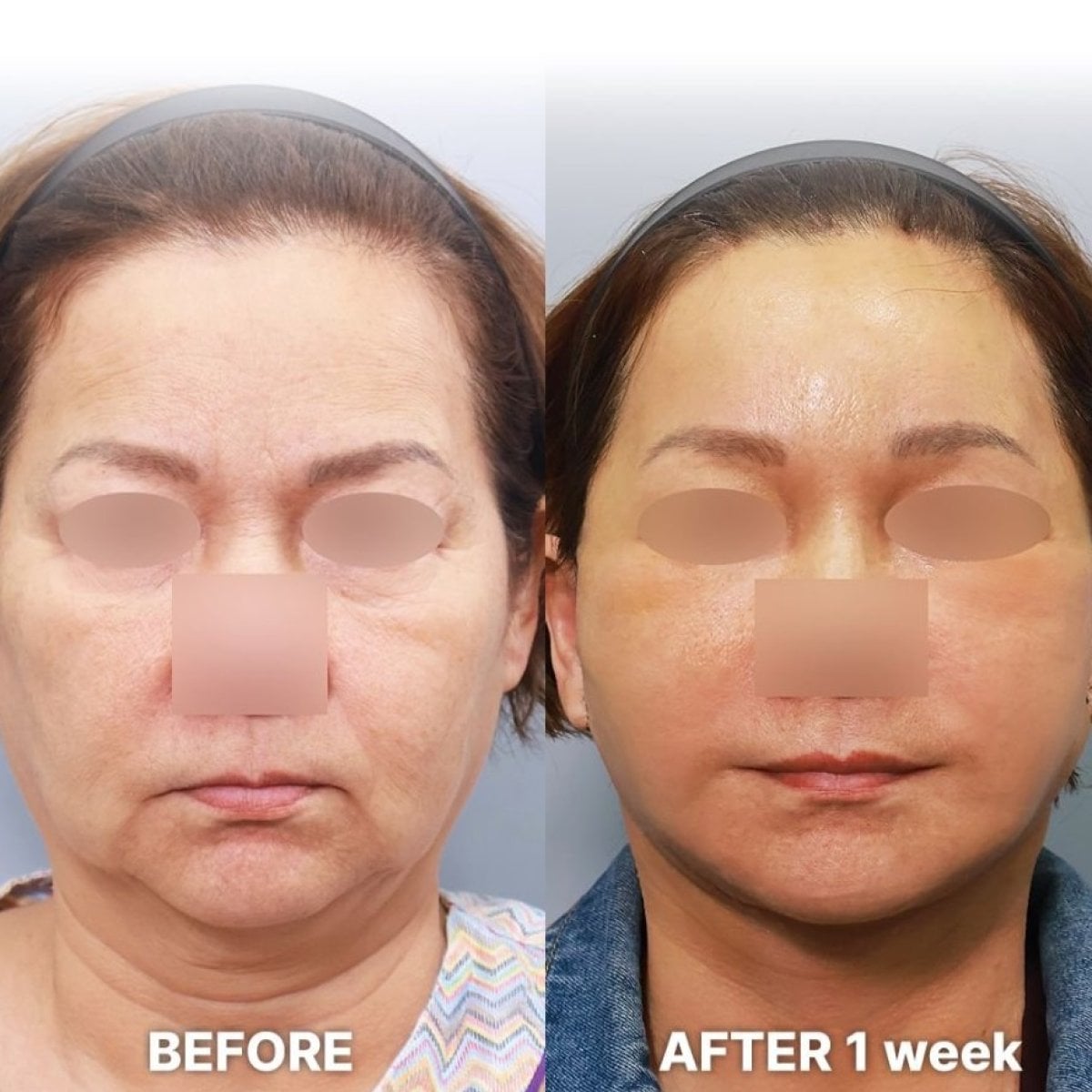 Antes y después de transferencia de grasa facial en Returning Plastic Surgery, resultado rejuvenecedor